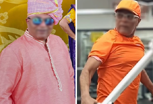 Before and After Image of a Patient undergone Bariatric Surgery - 2