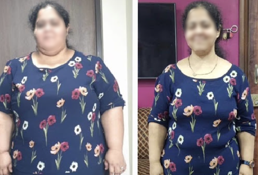 Before and After Image of a Patient undergone Bariatric Surgery - 3