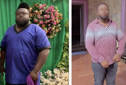 Before and After Image of a Patient undergone Bariatric Surgery - 4