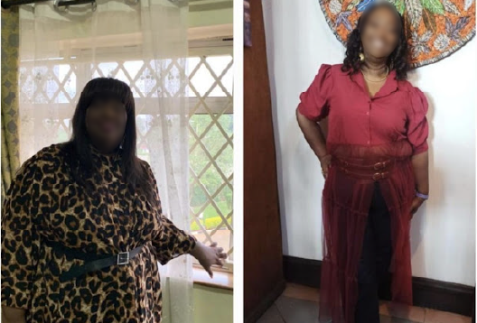 Before and After Image of a Patient undergone Bariatric Surgery - 5