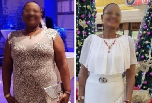Before and After Image of a Patient undergone Bariatric Surgery - 3
