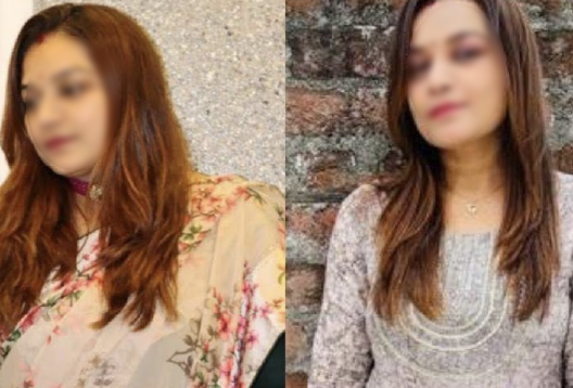 Before and After Image of a Patient undergone Bariatric Surgery - 1