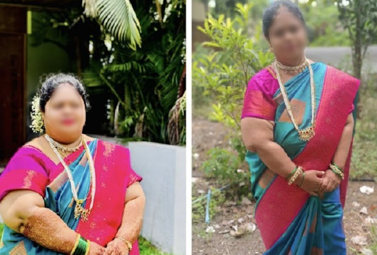 Before and After Image of a Patient undergone Bariatric Surgery - 4