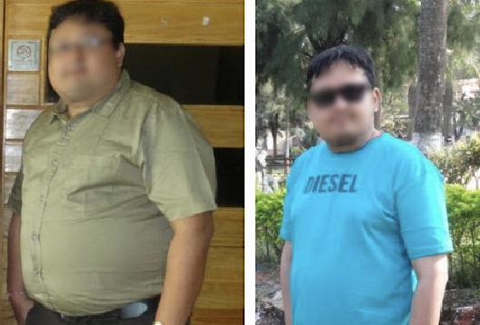 Before and After Image of a Patient undergone Bariatric Surgery - 5