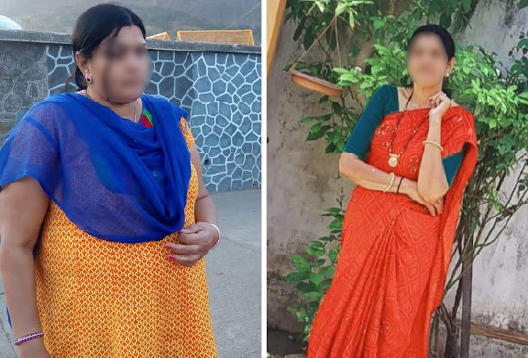 Before and After Image of a Patient undergone Bariatric Surgery - 1