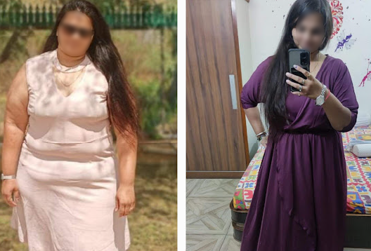 Before and After Image of a Patient undergone Bariatric Surgery - 2