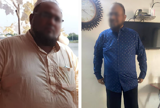 Before and After Image of a Patient undergone Bariatric Surgery - 3