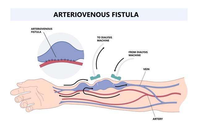 Av-Fistula