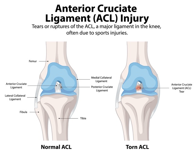 Acl-Tear