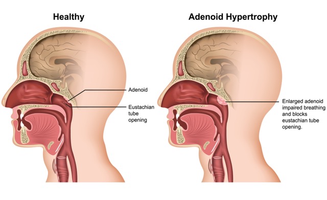 Adenoidectomy
