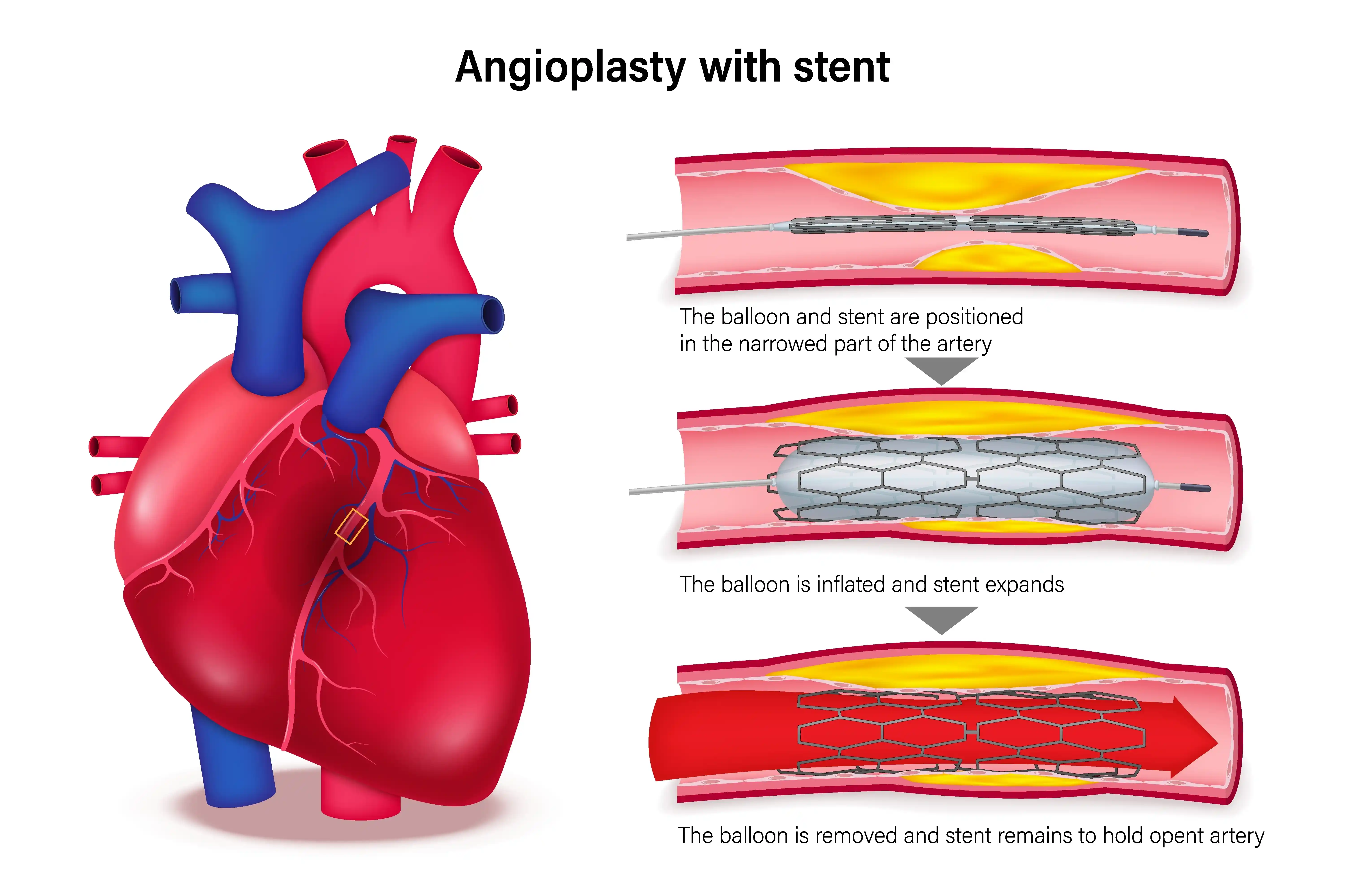angioplasty