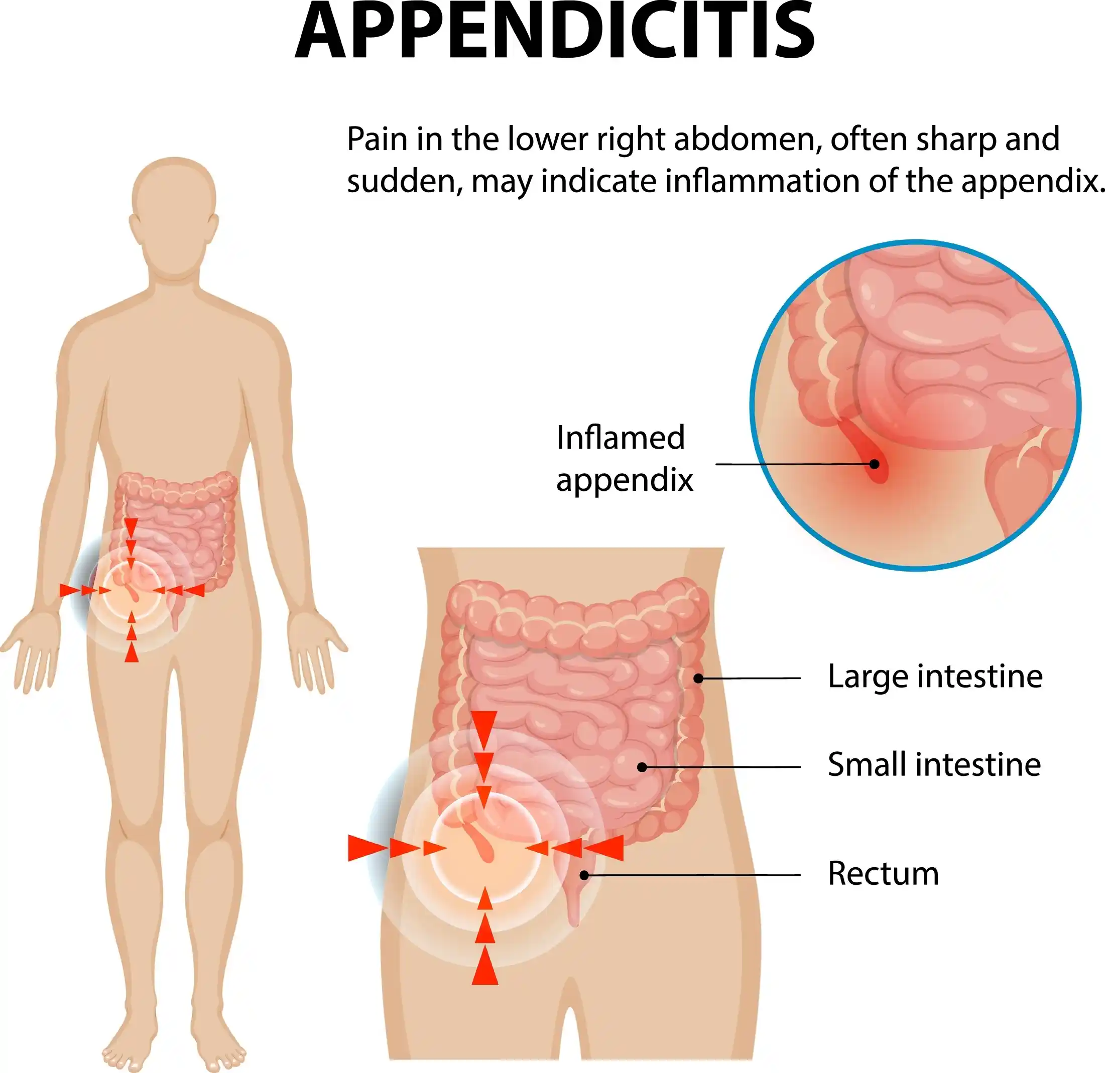 Appendicitis