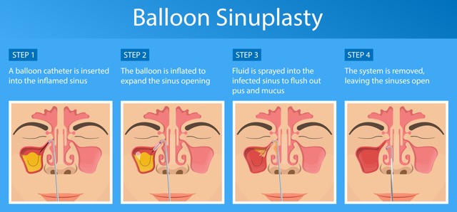 Balloon-Sinuplasty