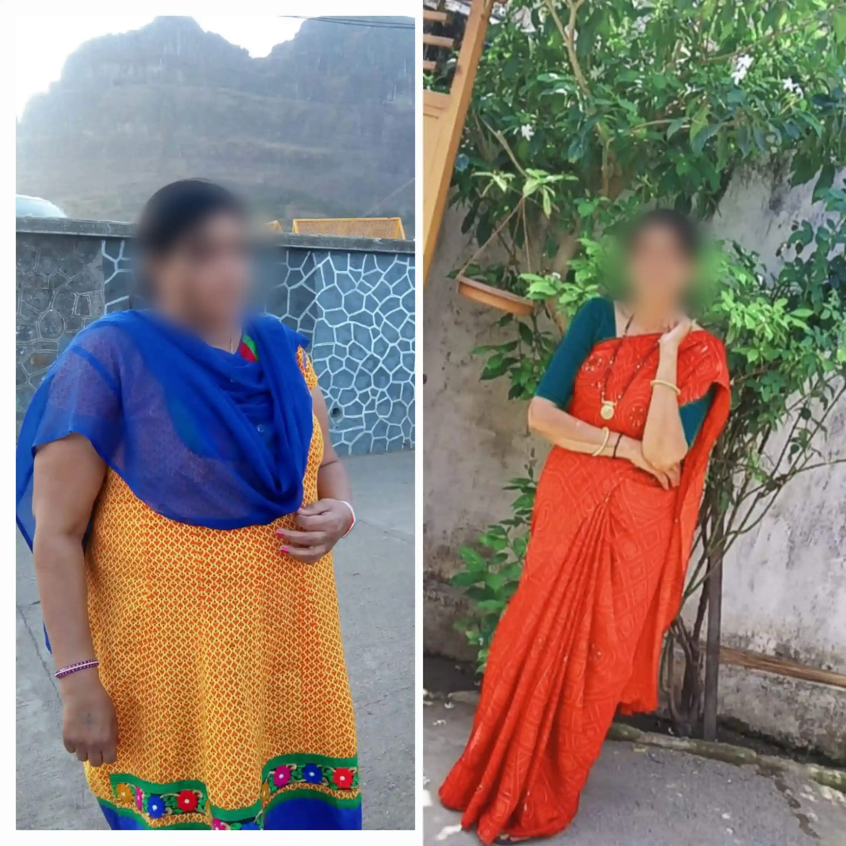 Before and After Image of a Patient undergone Bariatric Surgery - 1