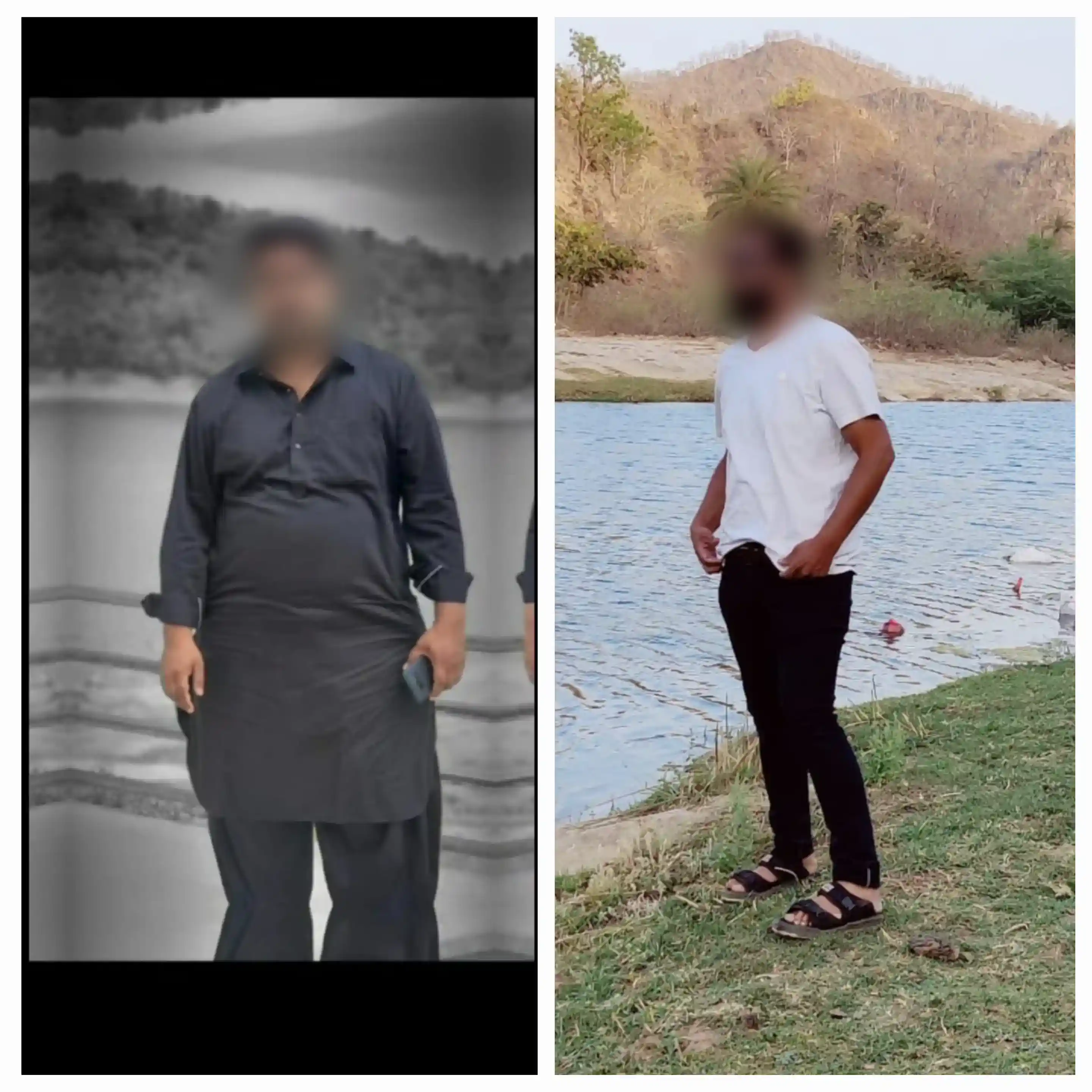 Before and After Image of a Patient undergone Bariatric Surgery - 2