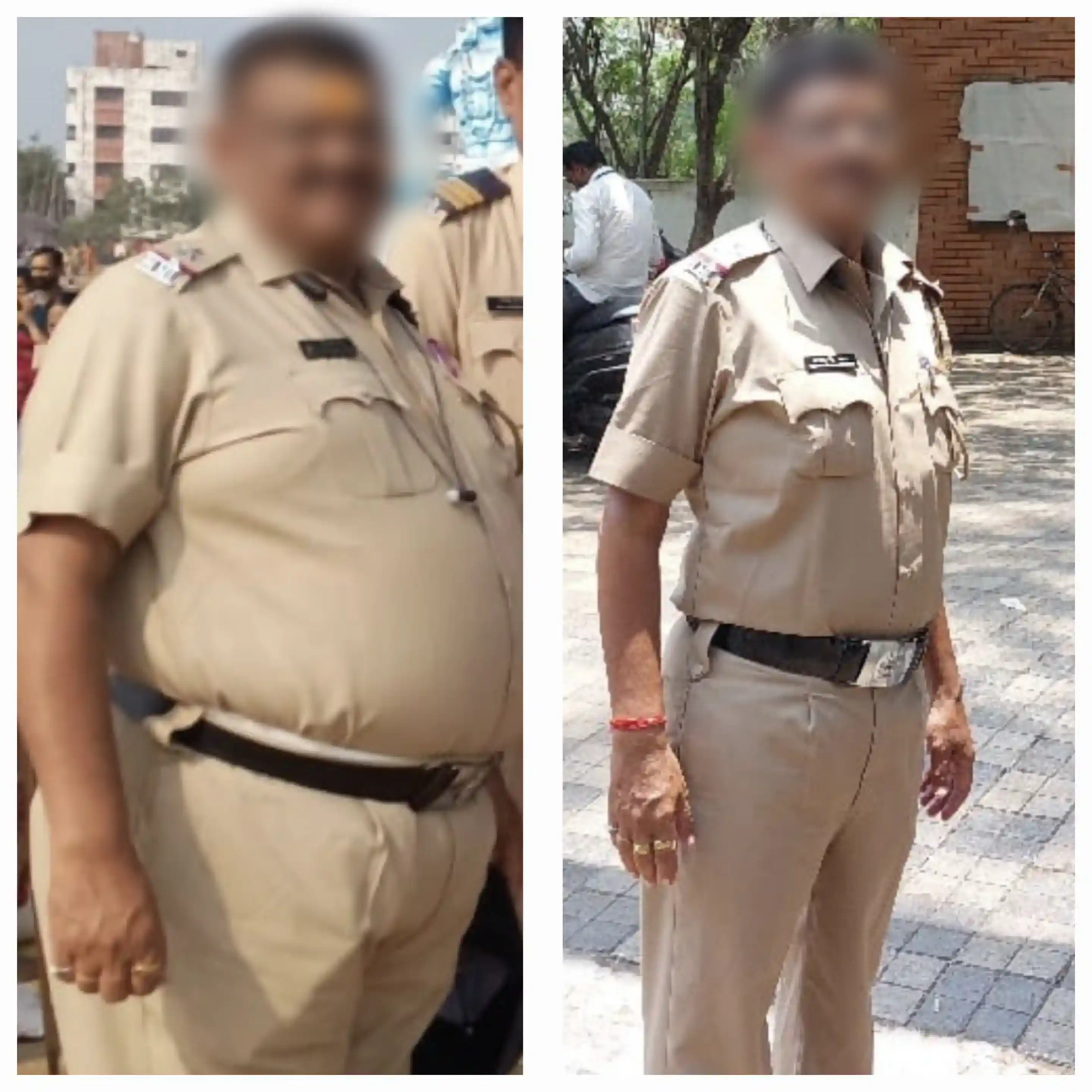 Before and After Image of a Patient undergone Bariatric Surgery - 3