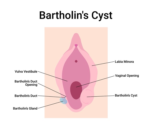 Bartholin-Cyst
