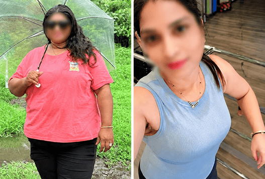 Before and After Image of a Patient undergone Bariatric Surgery - 6