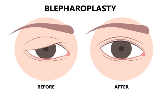 Blepharoplasty