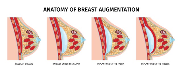 Breast-Augmentation