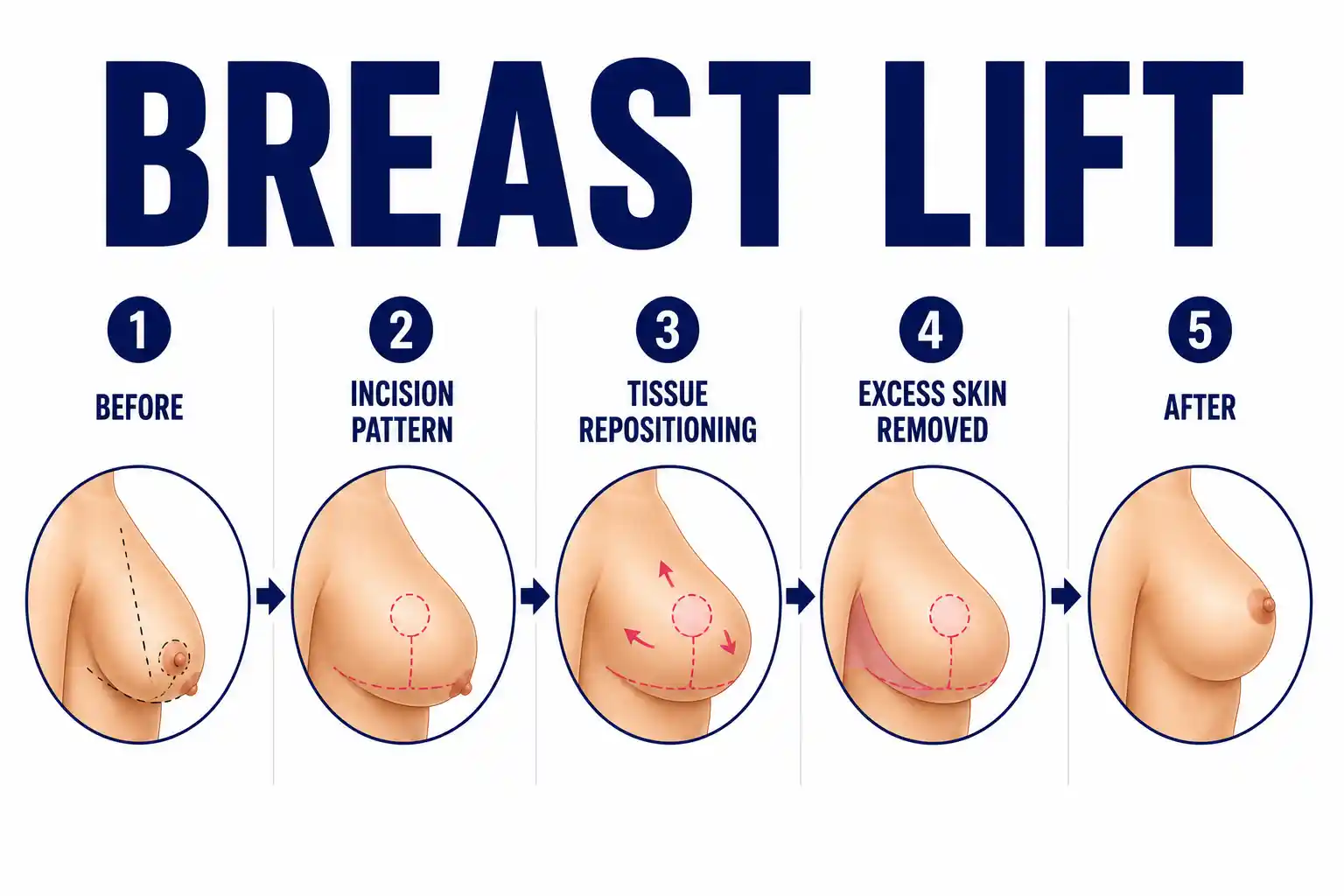 Breast-Lift
