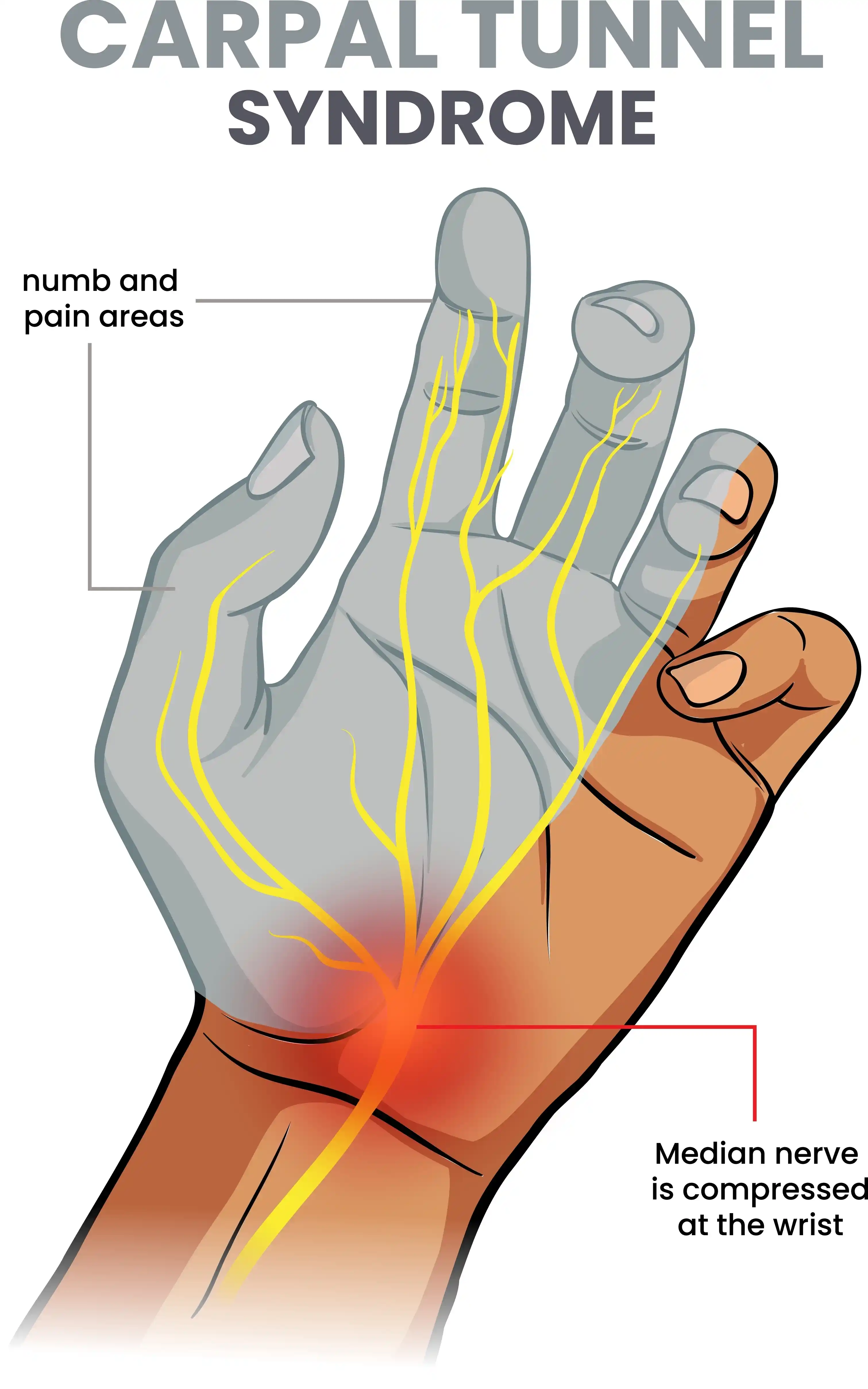 Carpal-Tunnel-Syndrome