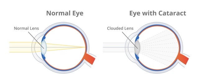 Cataract