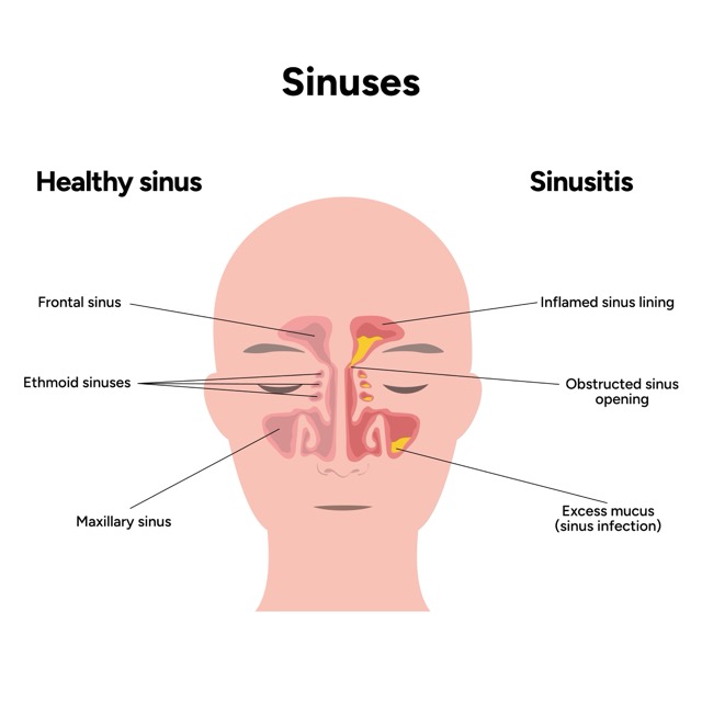 Chronic-Sinusitis