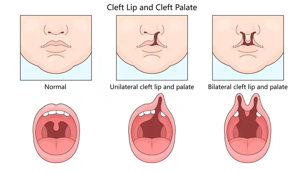 Cleft-Lip
