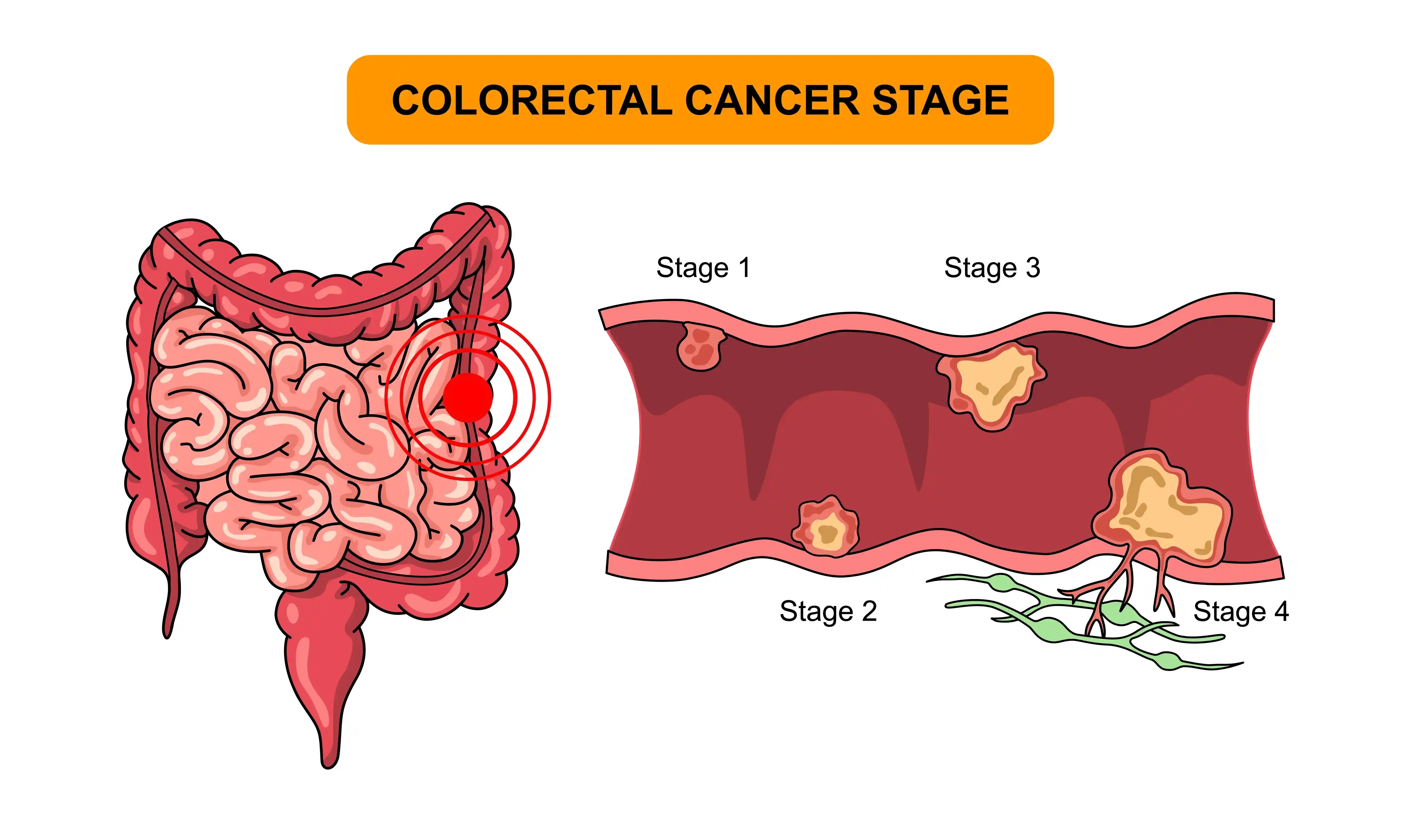 Colorectal