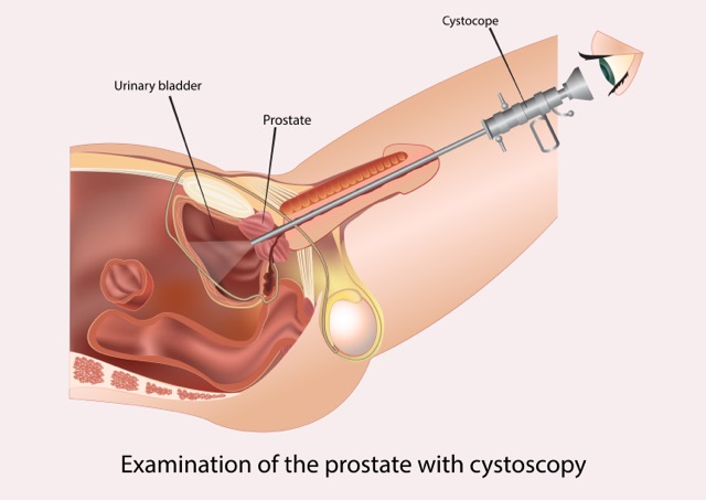 Cystoscopy