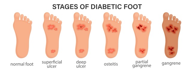 Diabetic-Foot-Ulcers