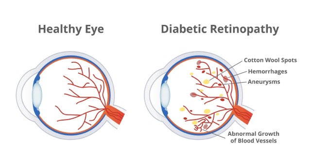 Diabetic-Retinopathy