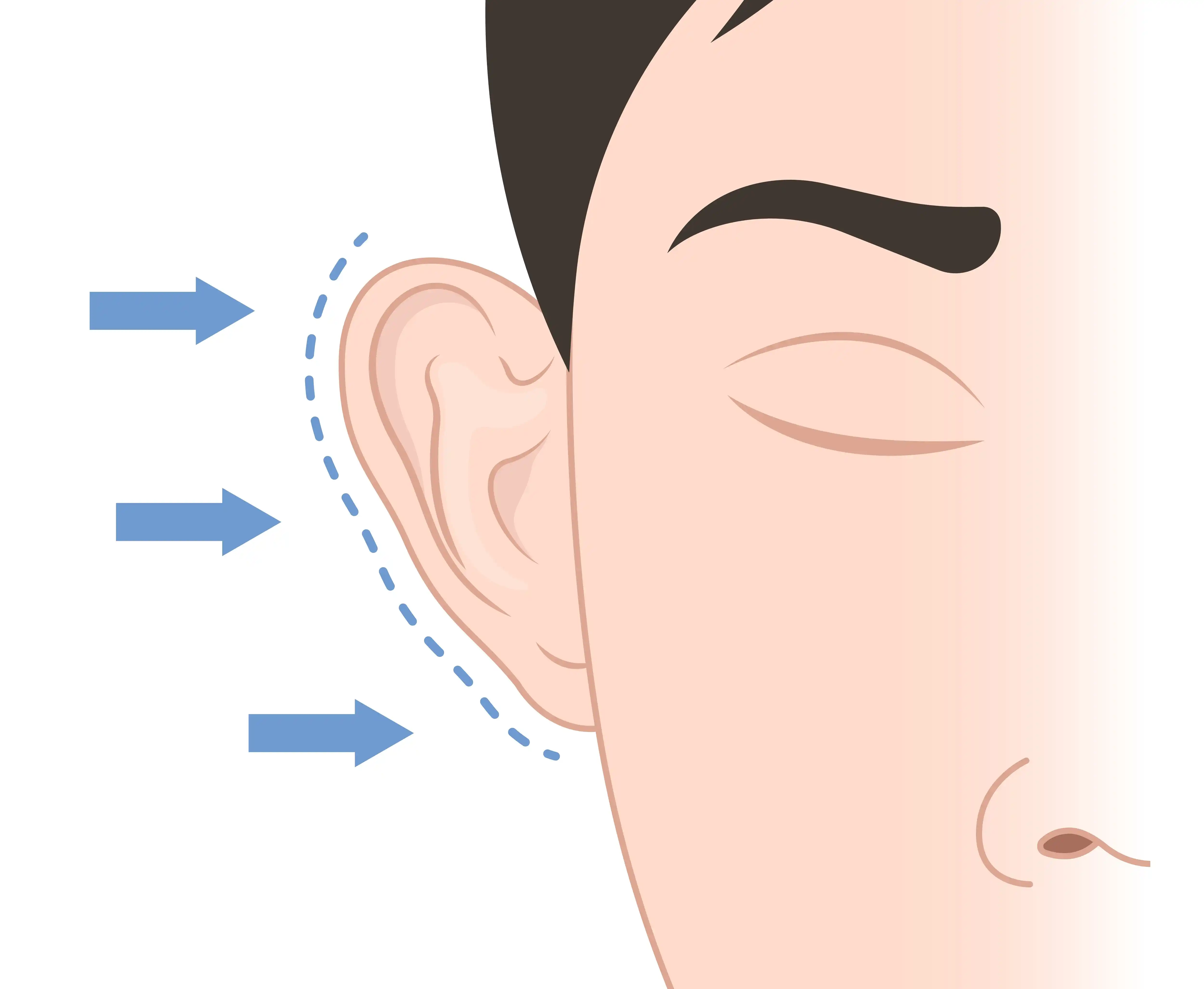Earlobe-Repair