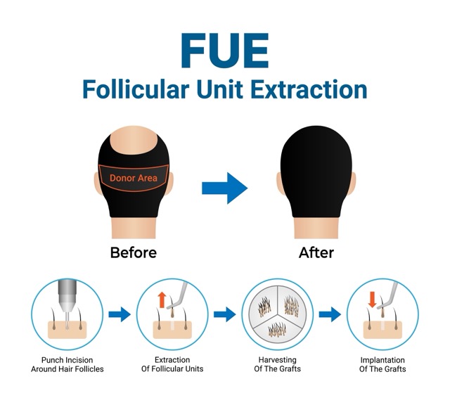 Follicular-Unit-Extraction-Fue