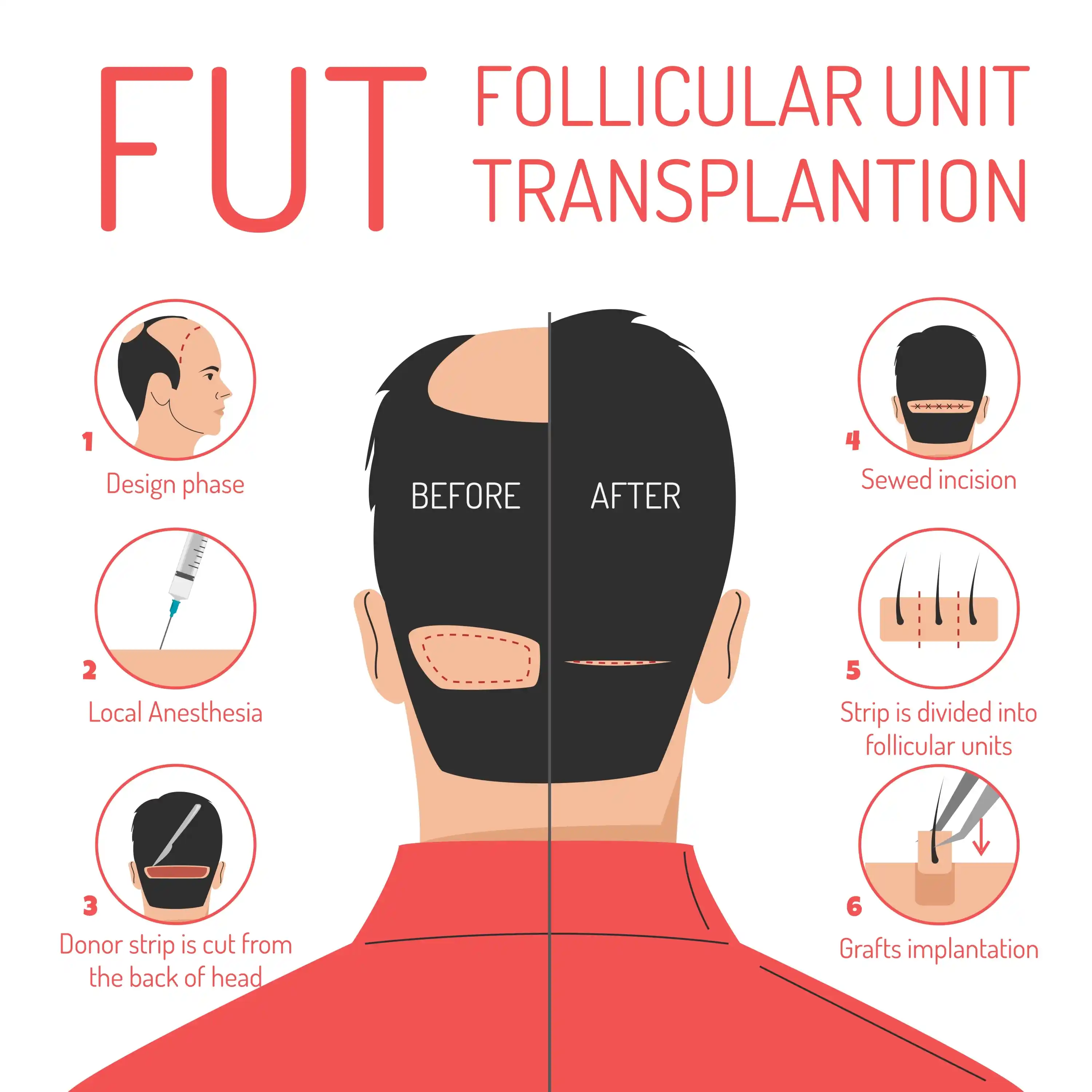 Follicular-Unit-Transplant-Fut