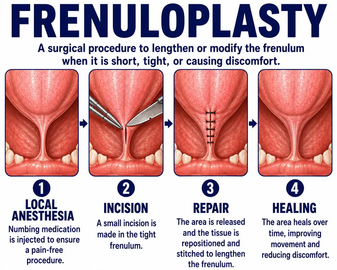 Frenuloplasty