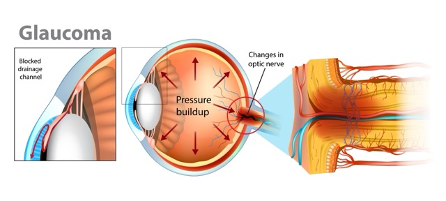 neovascular-glaucoma