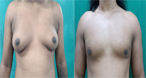 Before and After Images Gynecomastia Patient Undergone Surgery - 1