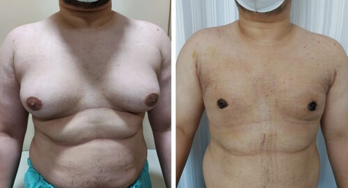 Before and After Images Gynecomastia Patient Undergone Surgery - 2