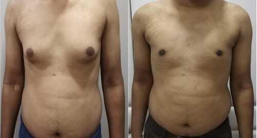 Before and After Images Gynecomastia Patient Undergone Surgery - 3