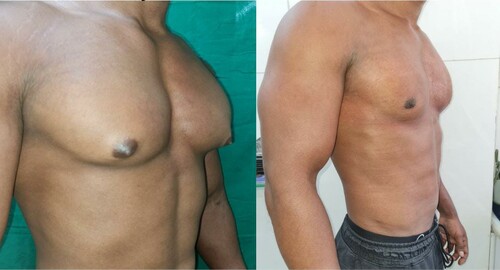 Before and After Images Gynecomastia Patient Undergone Surgery - 4