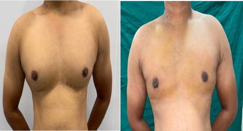 Before and After Images Gynecomastia Patient Undergone Surgery - 5