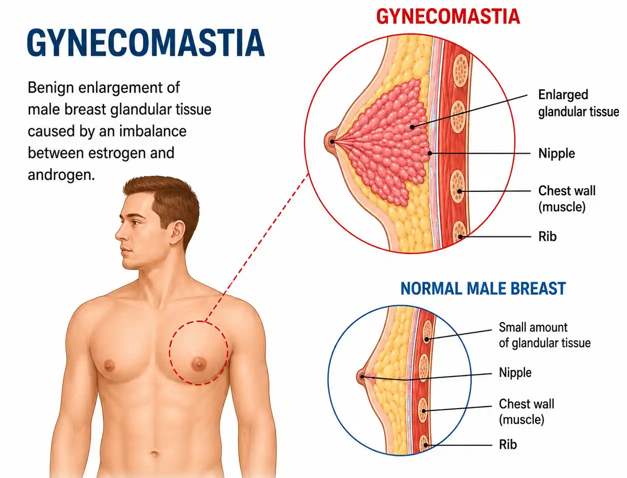 Gynecomastia