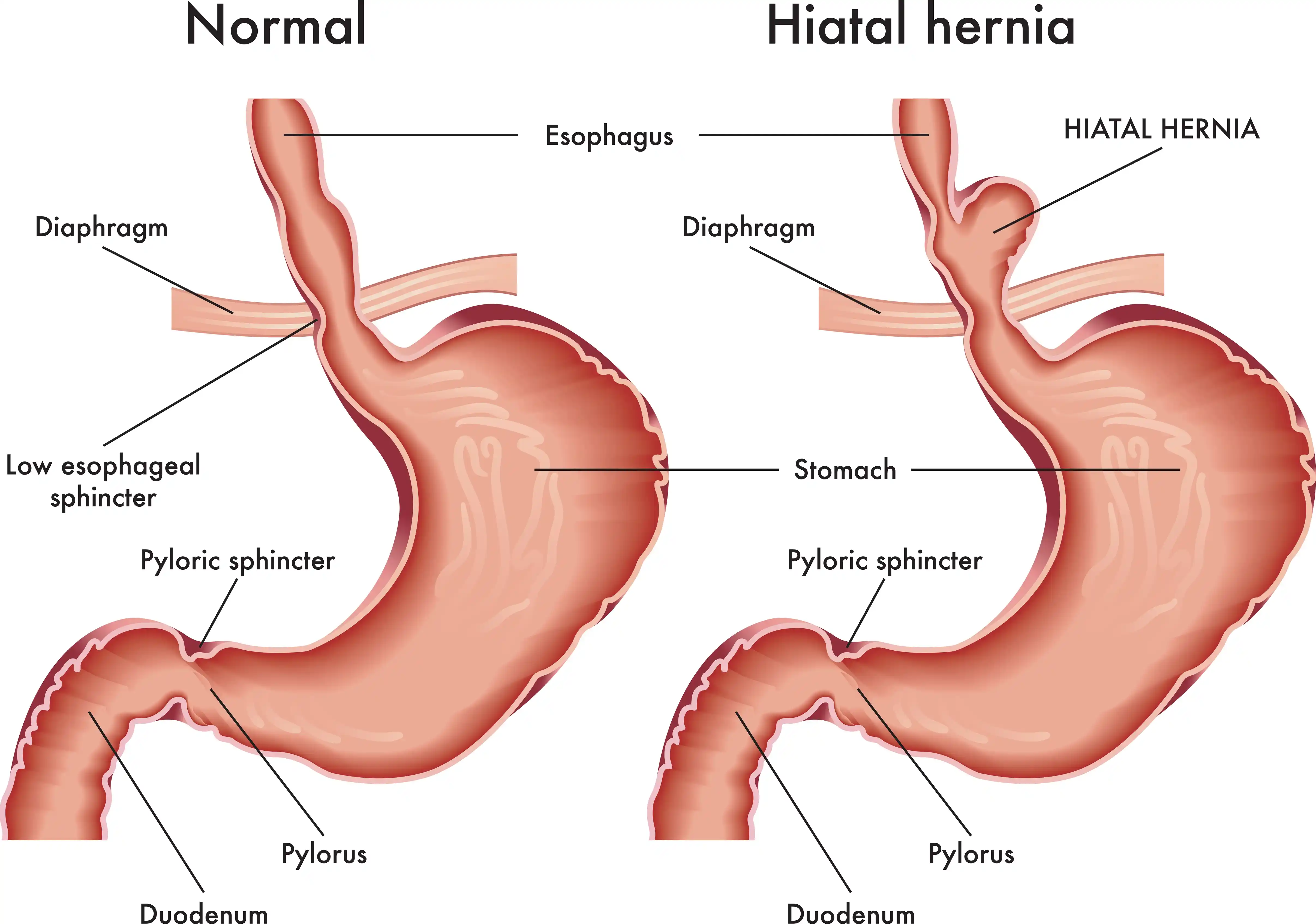 Hiatal-Hernia