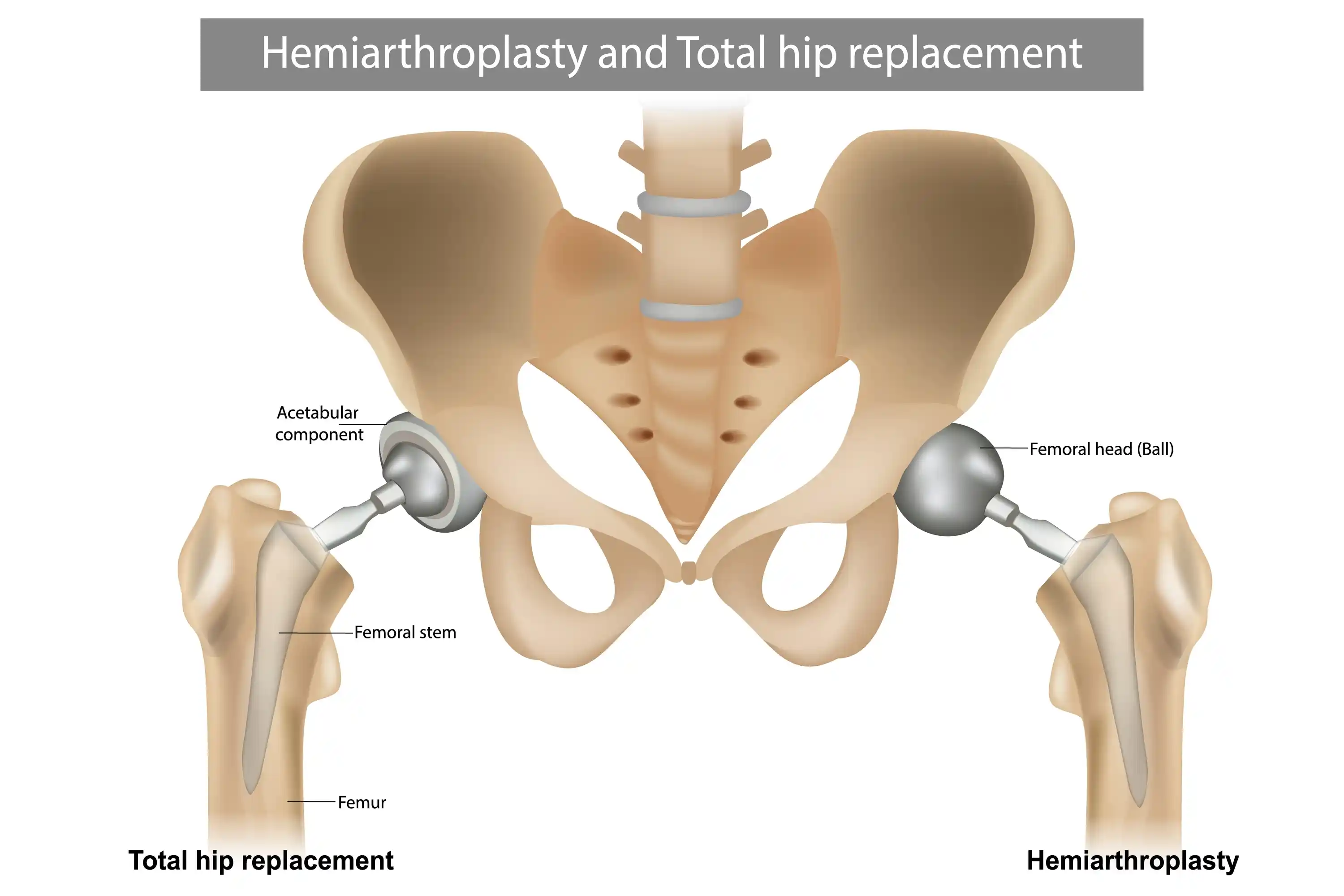 Hip-Replacement