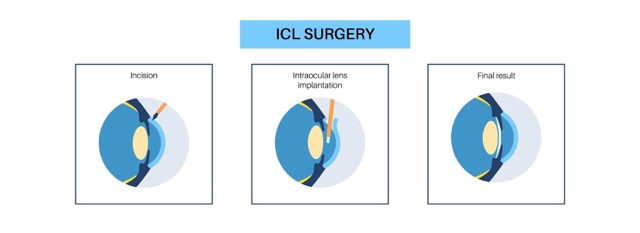 Icl-Surgery