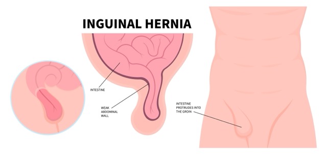 Inguinal-Hernia