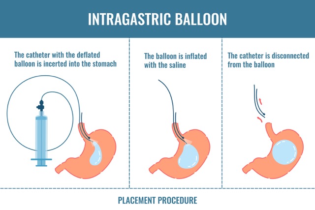 Intragastric-Balloon