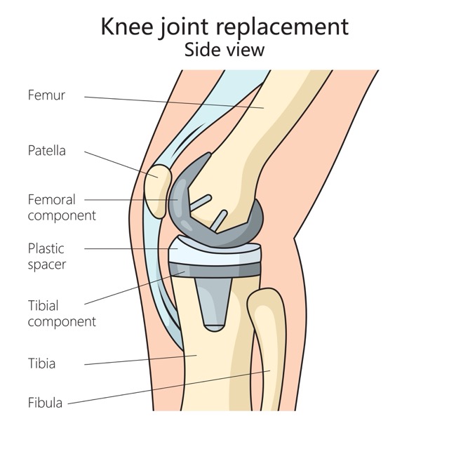 Joint-Replacement